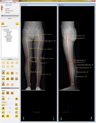 Analysis of lower extremity alignment (LEA) in children with recurrent patellar dislocation by EOS system